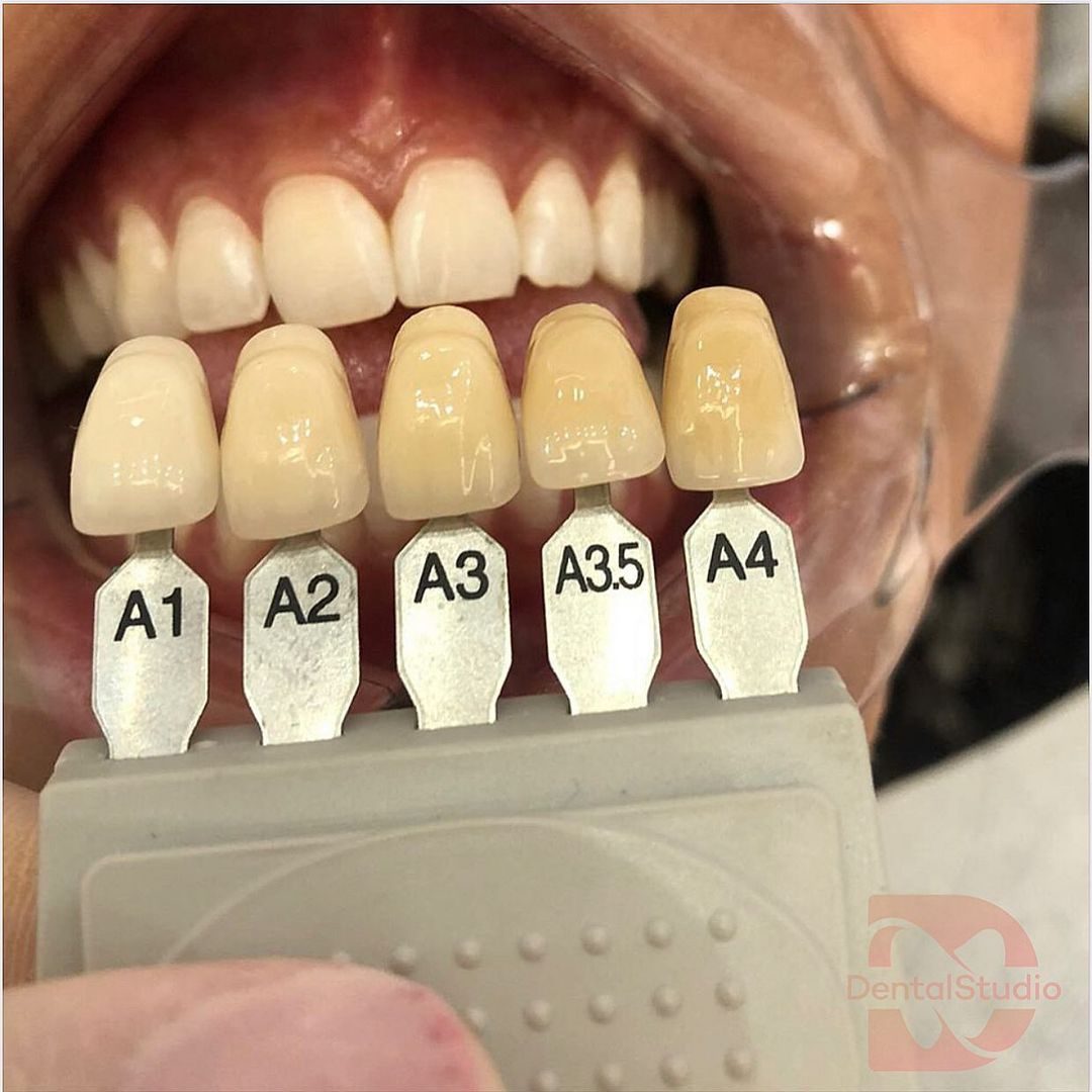 Clareamento Dental (1)